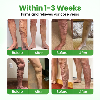Owiwell® VeinHeal Microneedle Patch